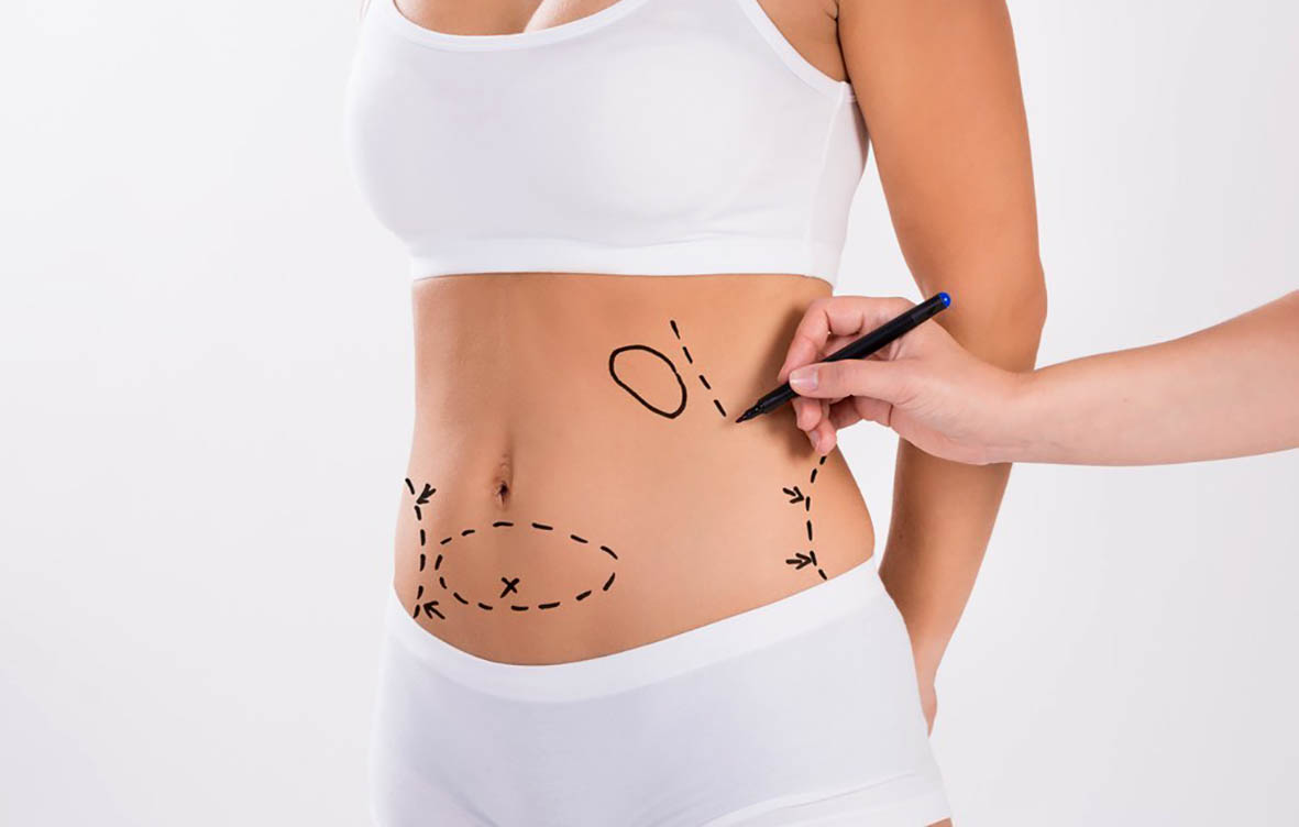 lipo cirurgia plastica