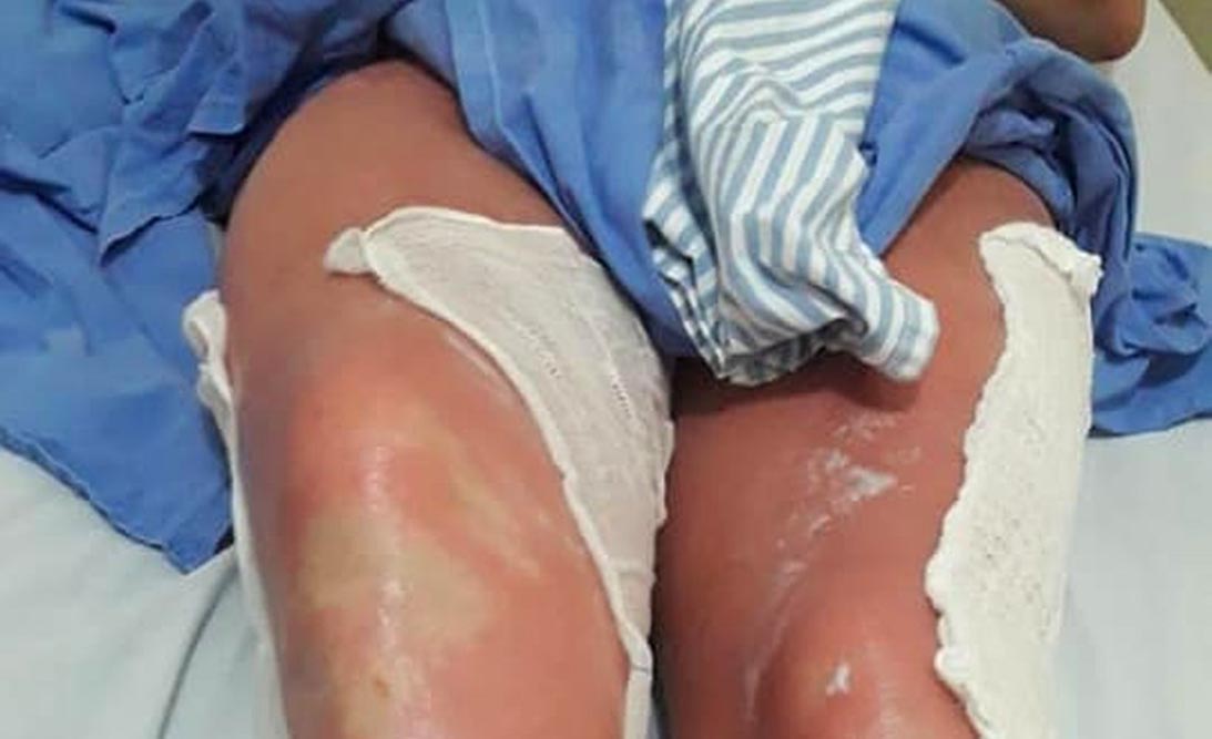 mulher se queima queimada queimadura bronzeamento -nova-xavantina